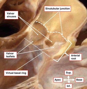 Surgical Anatomy of the Valves of the Heart (Chapter 4) - Wilcox's