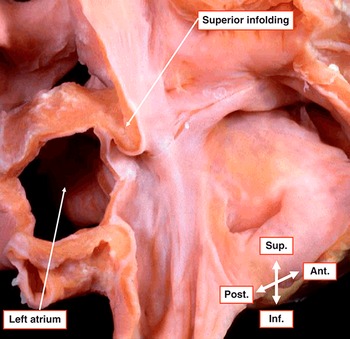 Anatomy of the Cardiac Chambers (Chapter 3) - Wilcox's Surgical