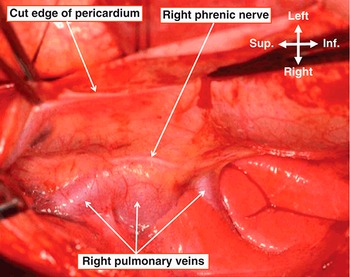 Surgical Approaches to the Heart (Chapter 1) - Wilcox's Surgical