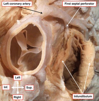 Surgical Anatomy of the Valves of the Heart (Chapter 4) - Wilcox's