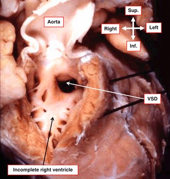 Surgical Anatomy of the Heart: Wilcox, Benson R., Cook