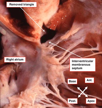 Surgical Anatomy of the Valves of the Heart (Chapter 4) - Wilcox's