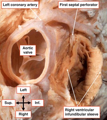 Wilcox's Surgical Anatomy of the Heart: 9781107014480