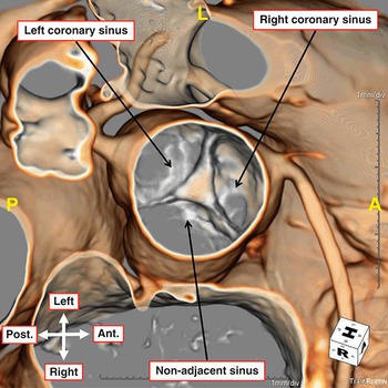 Surgical Anatomy of the Coronary Circulation (Chapter 5