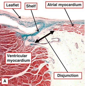 Surgical Anatomy of the Valves of the Heart (Chapter 4) - Wilcox's