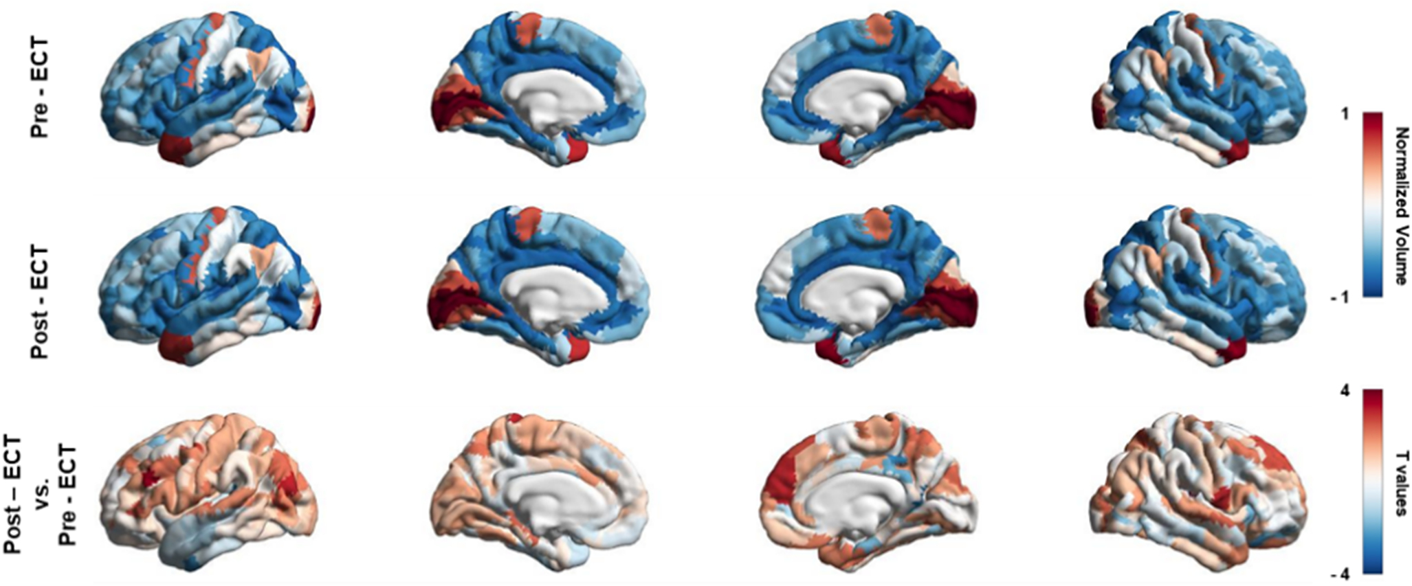 Alterations in gray matter volume and associated transcriptomics after ...
