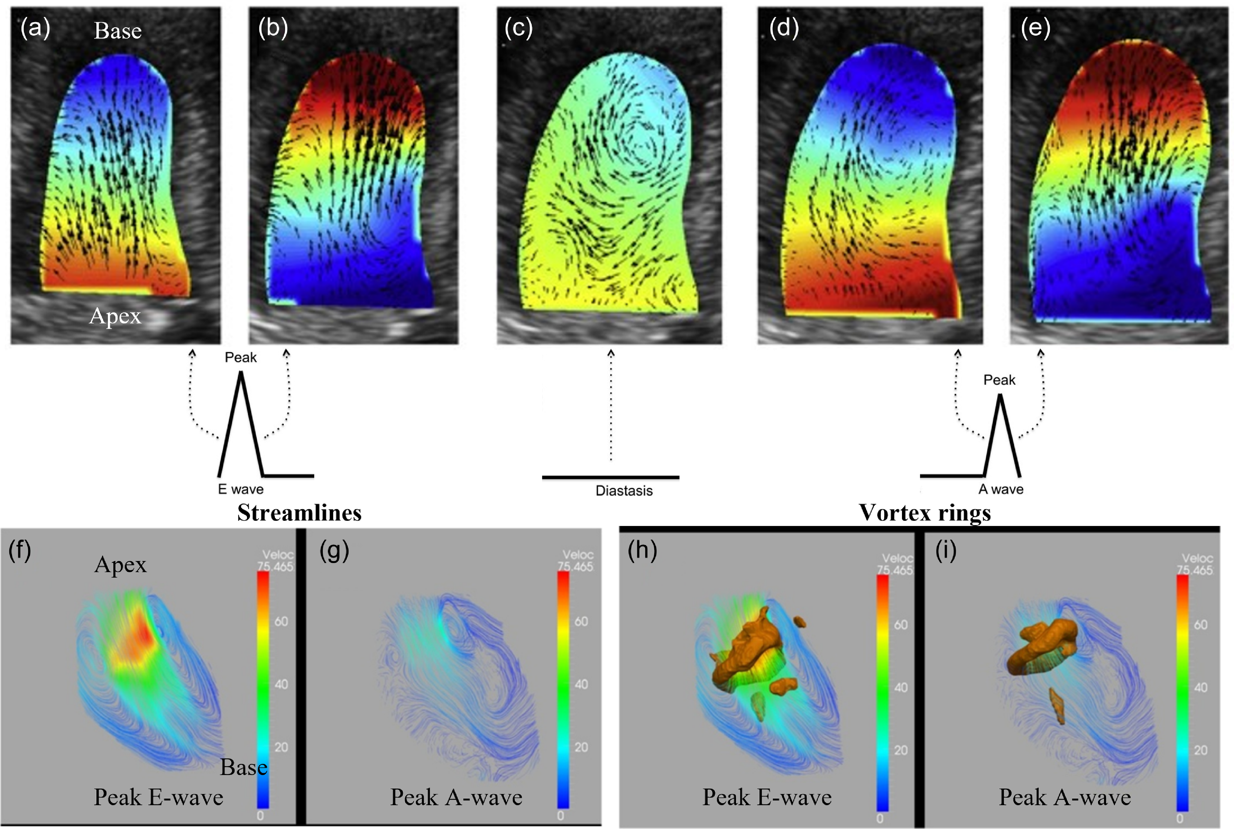 A review on vortex dynamics in the healthy and dilated left ventricles ...