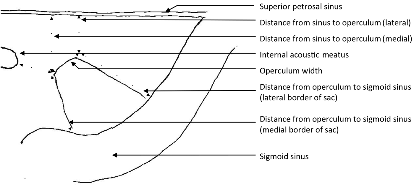 Endolymphatic sac surgical anatomy and transmastoid decompression of ...
