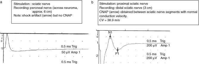 Intraoperative Nerve Stimulation: A Simple, Effective, and