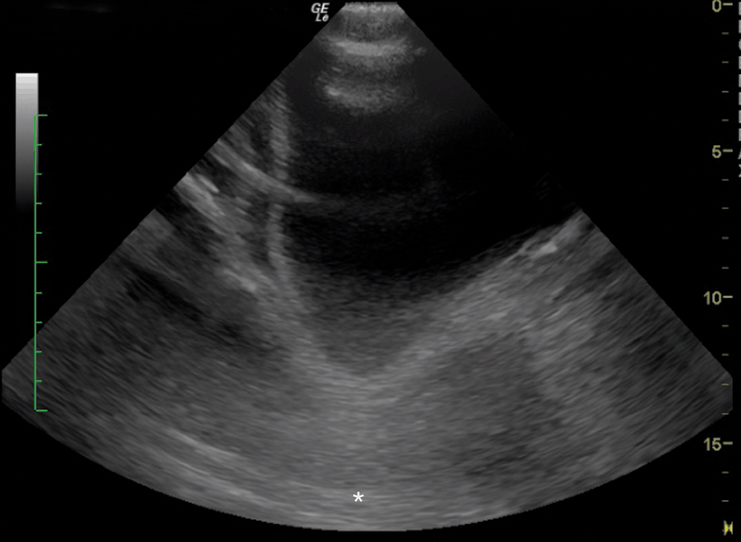 spatial-resolution-artifact-ultrasound-get-images