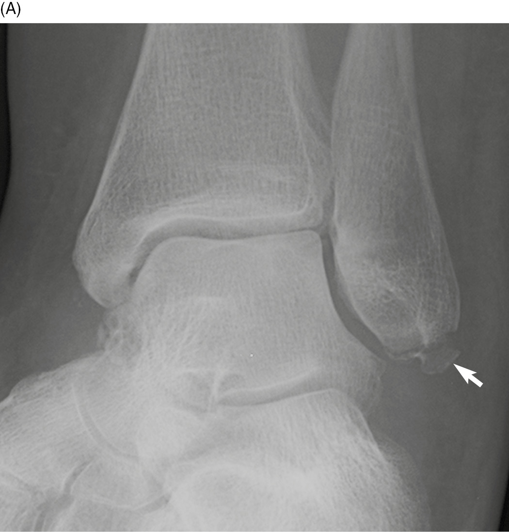 avulsion fracture ankle malleolus