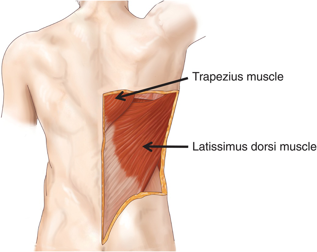 Chest (Section 5) - Atlas of Surgical Techniques in Trauma Chest (Section 5) - Atlas of Surgical Techniques in Trauma