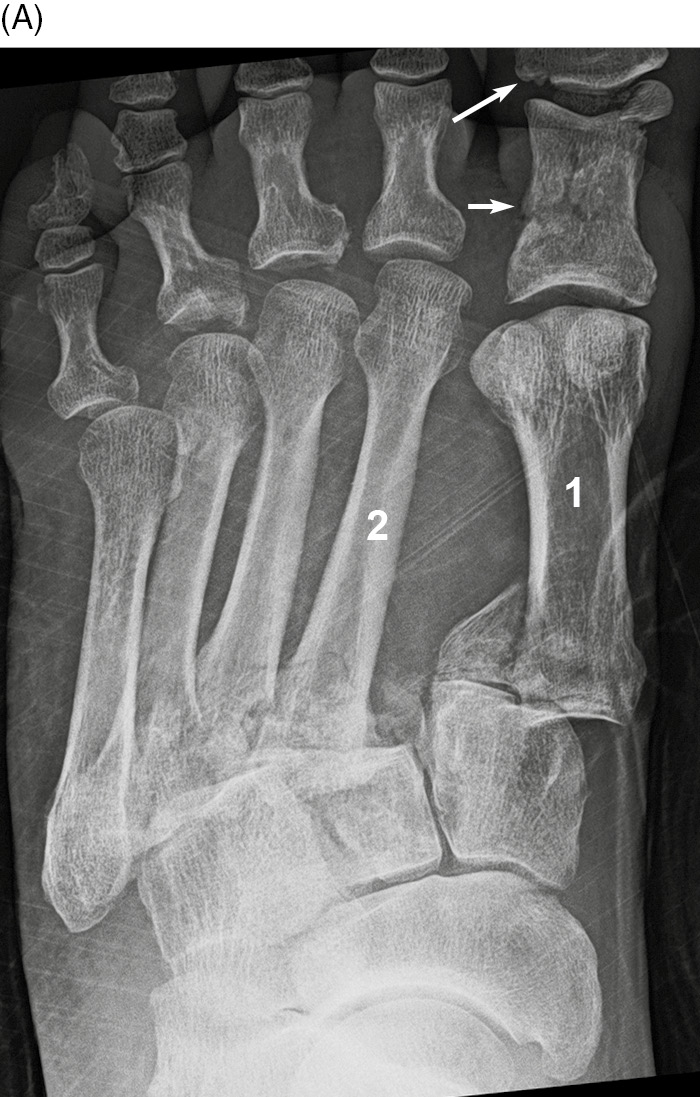dislocated second toe surgery