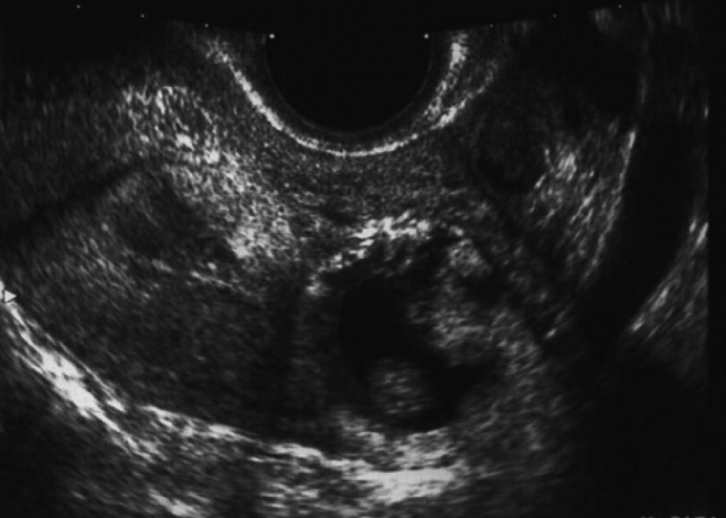 Cornual Pregnancy Mri Pregnancywalls