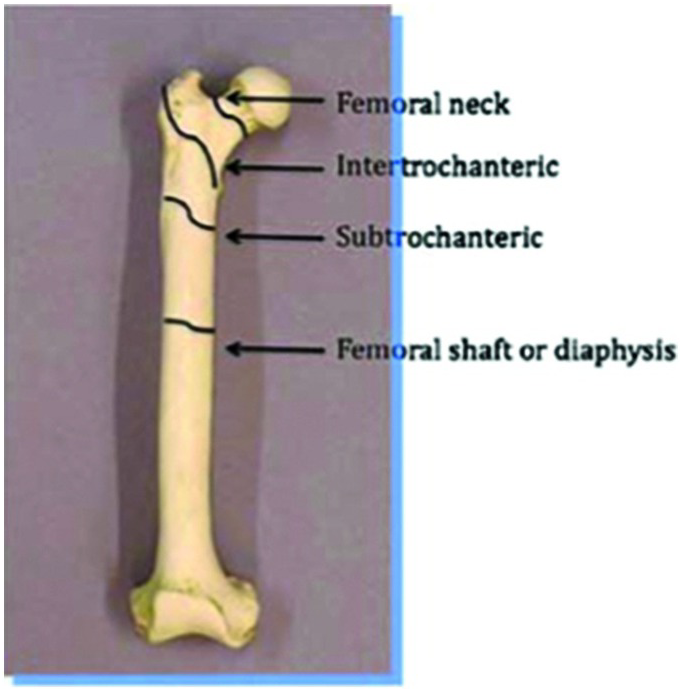 431 Can a bone stimulator help a stress fracture? - DOC
