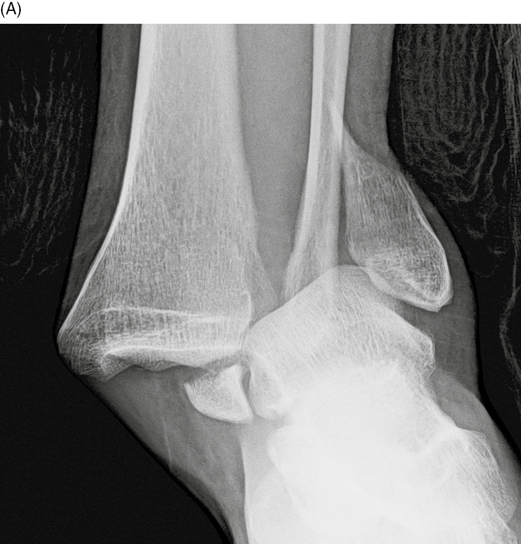 left trimalleolar ankle fractures dislocations
