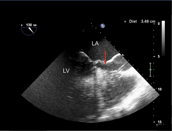 Case 43: Significant Spontaneous Echo Contrast In Left Ventricle (  DCM/Severe LV Dysfunction / LVEF : 15% in M- Mode / LVEF : 10% In Simpson's  Method., By Interesting cases in Echocardiography