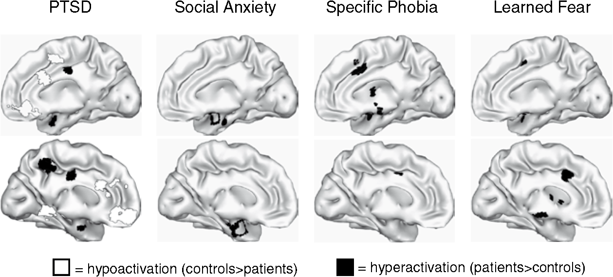 anxiety disorder brain