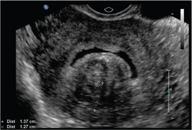 Sonohysterography Chapter 5 Ultrasonography In Reproductive Medicine And Infertility