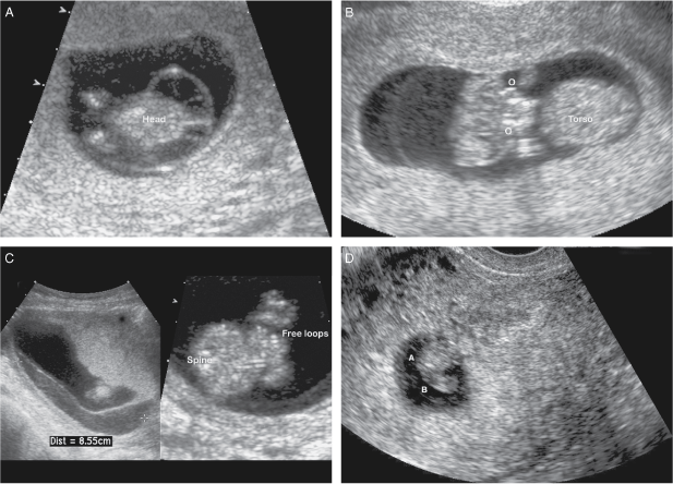 6 week twin ultrasound ivf｜TikTok Search