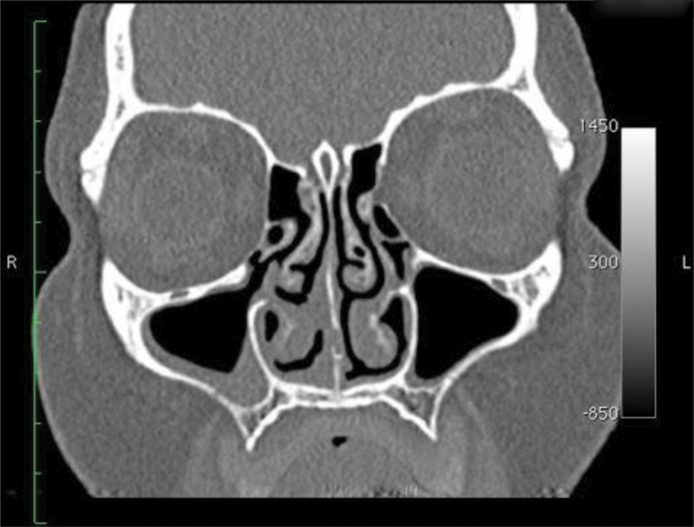 Cerebrospinal Fluid Rhinorrhoea After Nasal Packing For Epistaxis: Case 