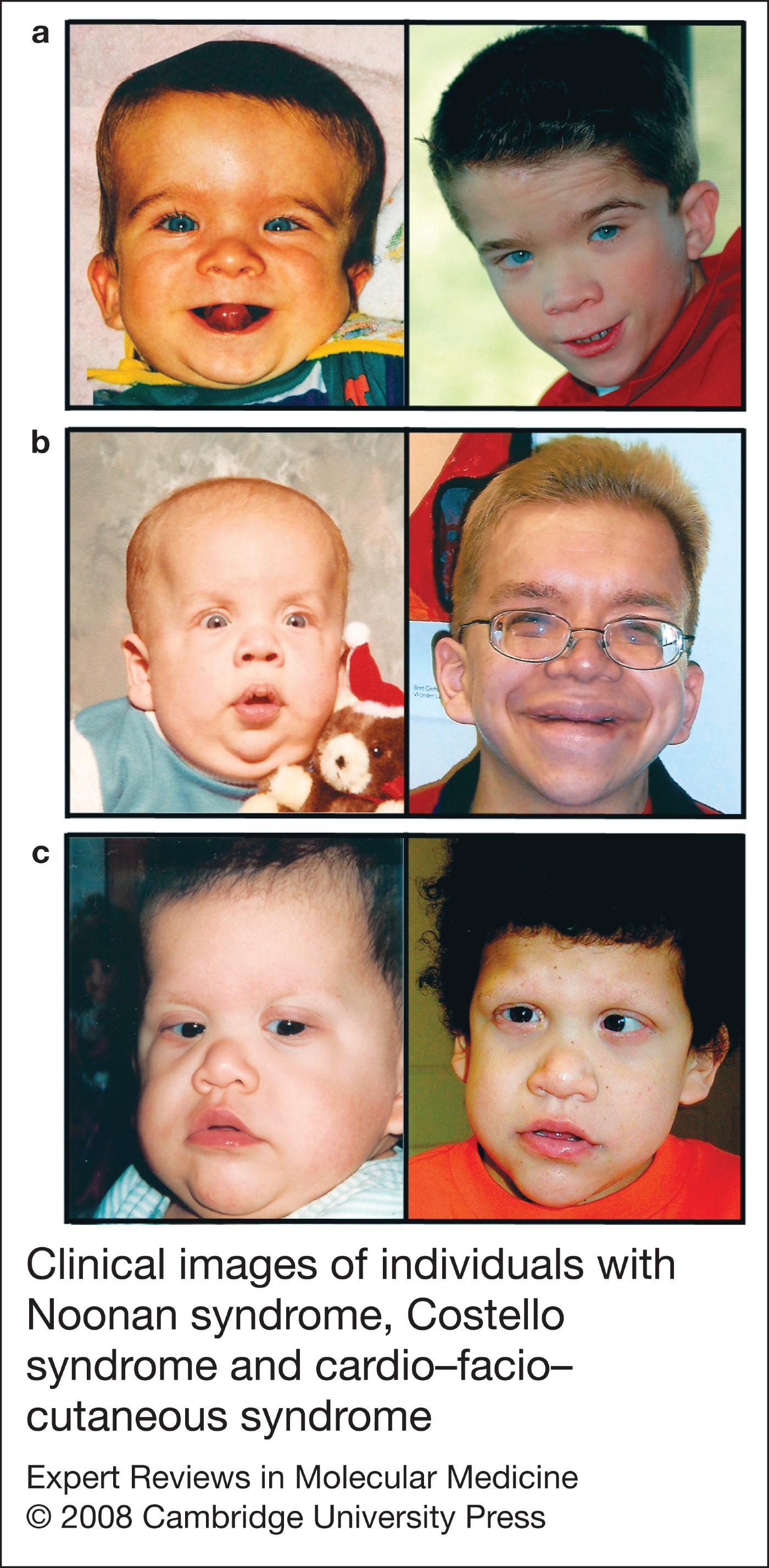 Noonan, Costello and cardiofaciocutaneous syndromes dysregulation of