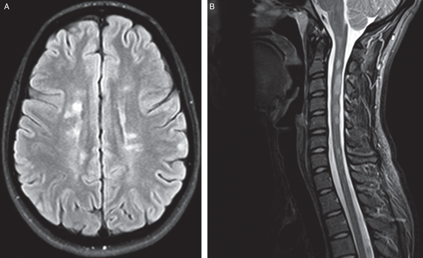 45+ Multiple Sclerosis Cervical Spinal Stenosis Cervical Spine Mri Pictures