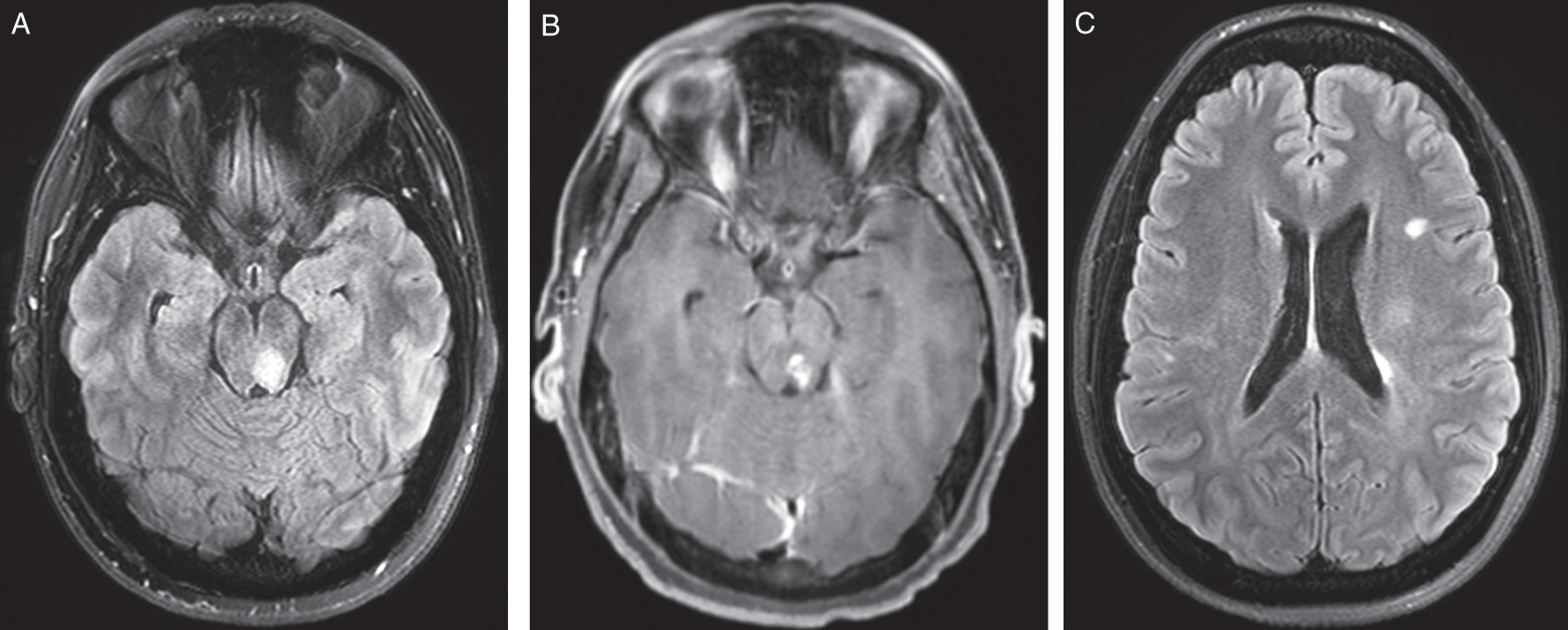 View Multiple Sclerosis Normal Vs Abnormal Brain Mri Images Pictures