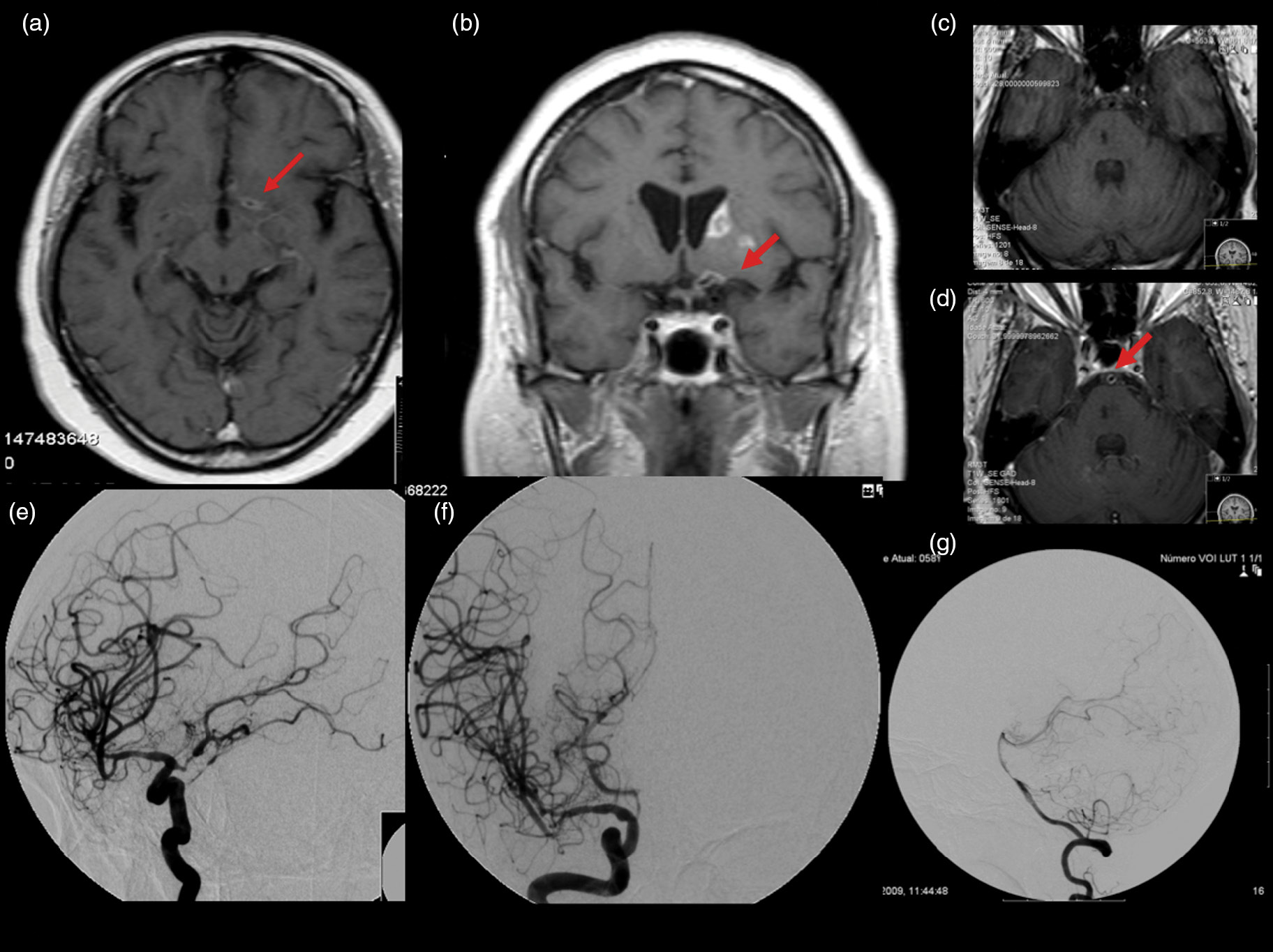 vasculitis cerebral imagenes
