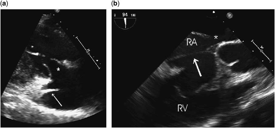 Exercise-induced hypoxia secondary to an atrial septal defect and cor ...