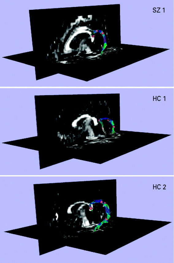 Electrophysiological and diffusion tensor imaging evidence of