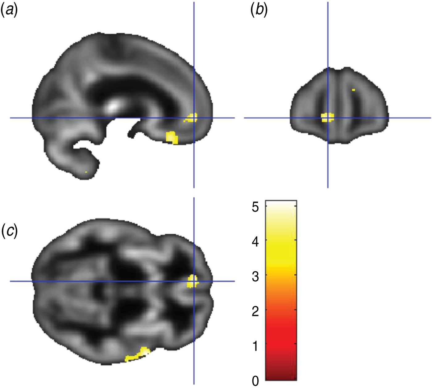 Reduced gray matter volume in the anterior cingulate, orbitofrontal ...