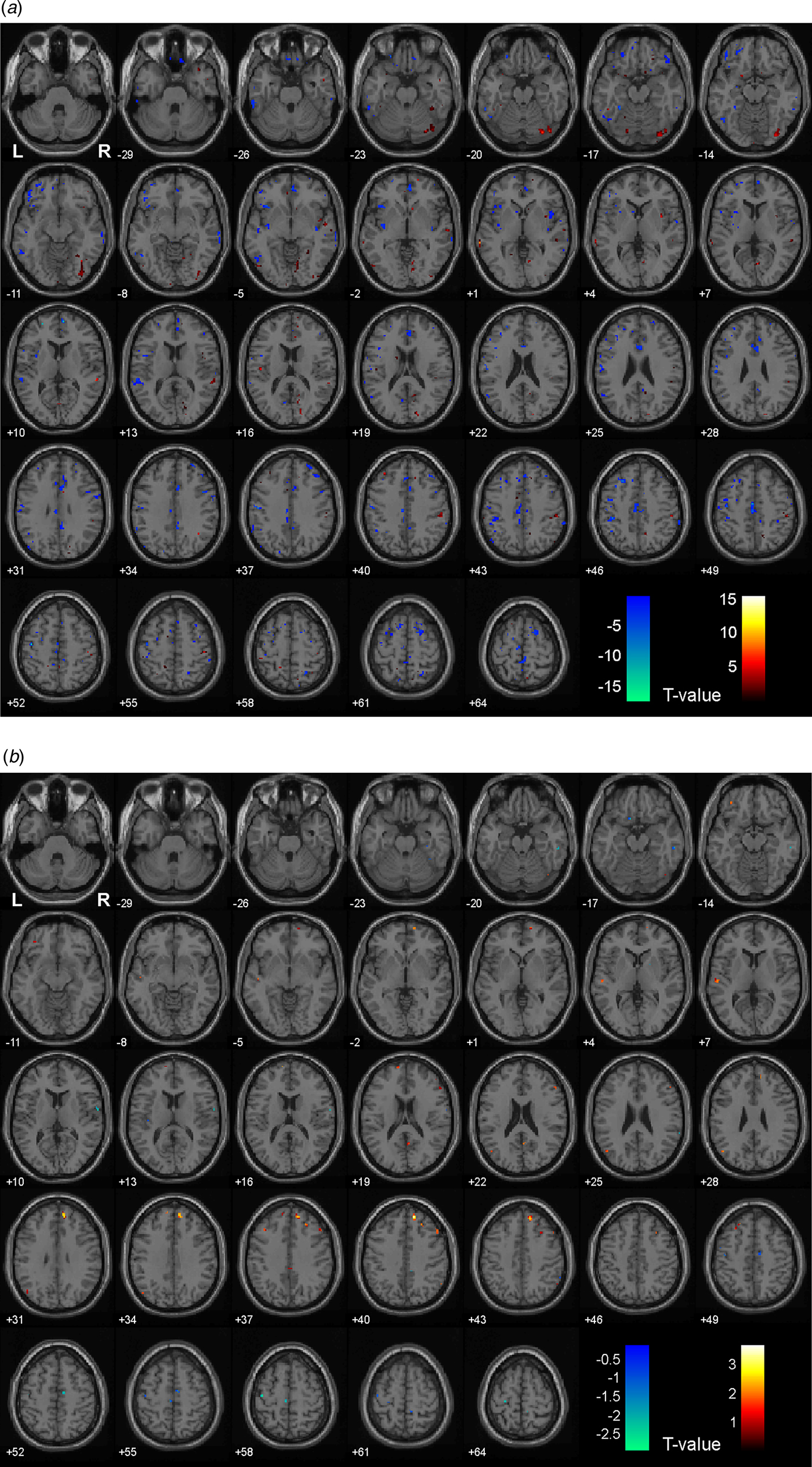 seizure therapy in treatmentresistant depression clinical, neuropsychological and