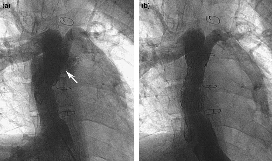 The use of a self-expandable stent with a self-expandable stent graft ...