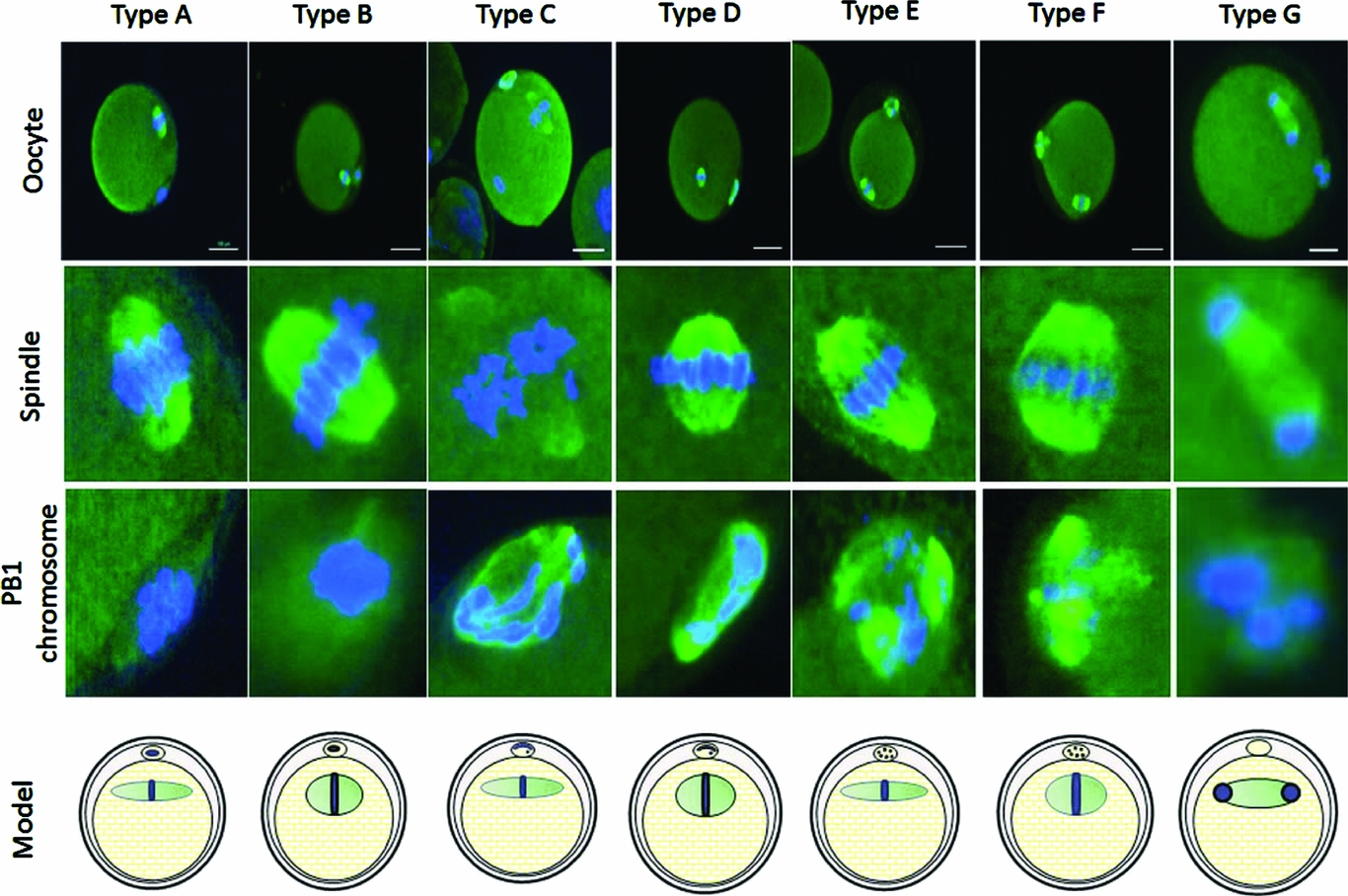Combination of spindle and first polar body chromosome images for the