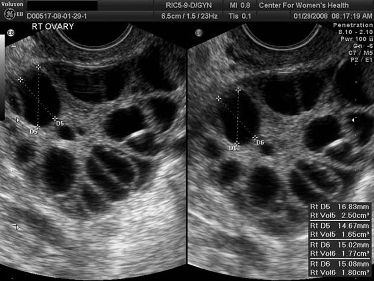 Ovarian Hyperstimulation Syndrome