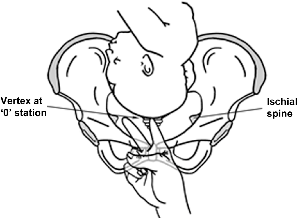 Pelvic and Fetal Cranial Anatomy and the Stages and Mechanism of