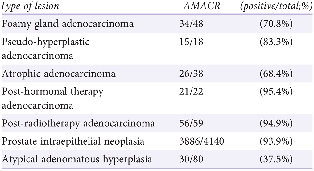 adenocarcinoma bilateral de próstata gs 4 300 adenocarcinoma bilateral de próstata gs 4 300