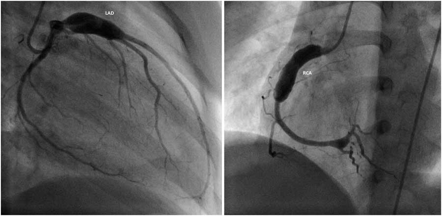 Giant coronary artery aneurysms in Kawasaki disease: the cost of a ...