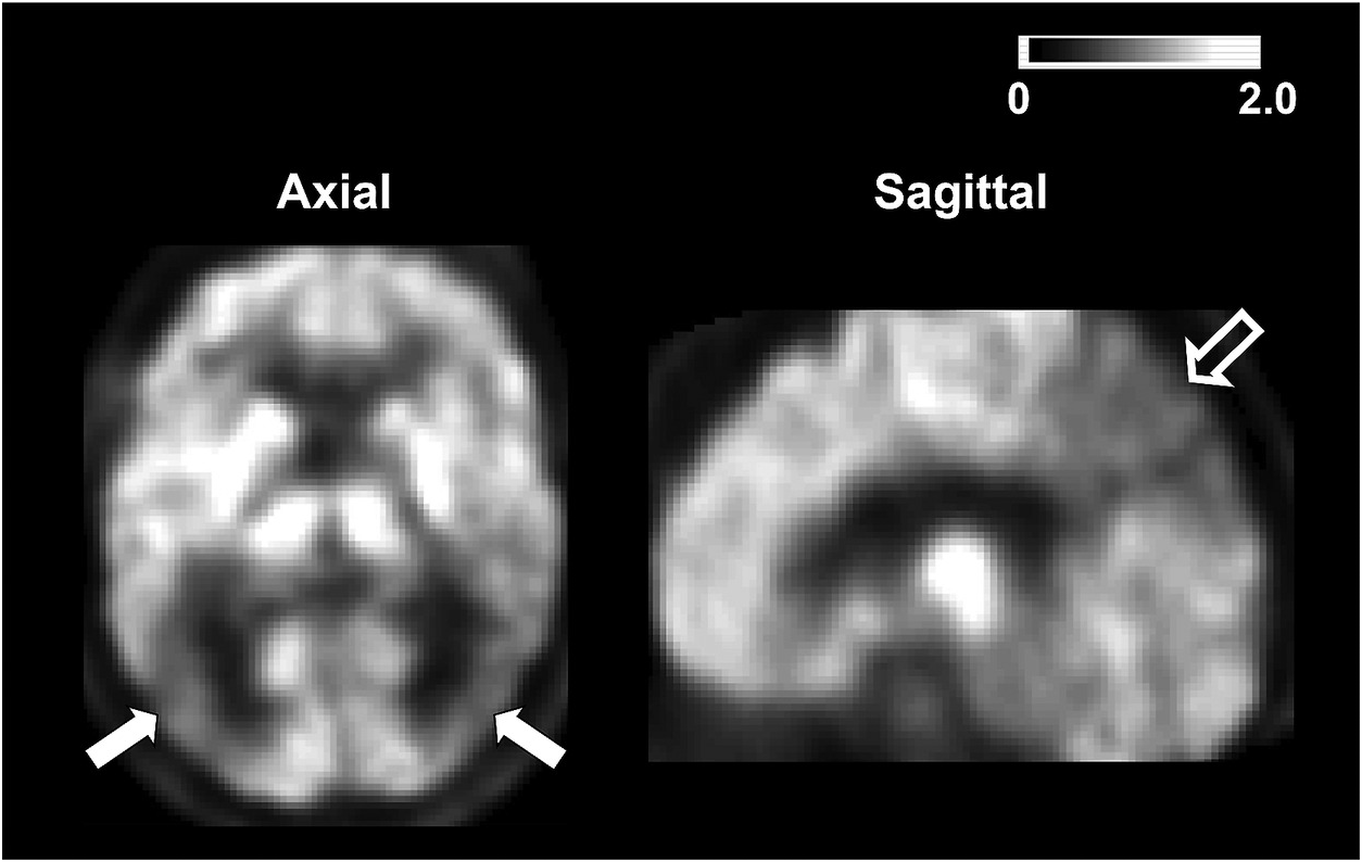 Neuroimaging in dementia (Chapter 3) - The Behavioral