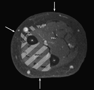 Soft tissue trauma (Chapter 19) - Trauma