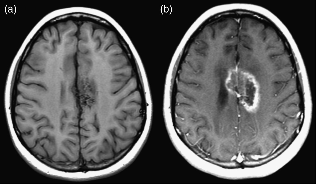 Tectal Glioma In Adults