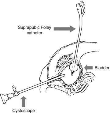 Management of bladder and sexual dysfunction in multiple sclerosis