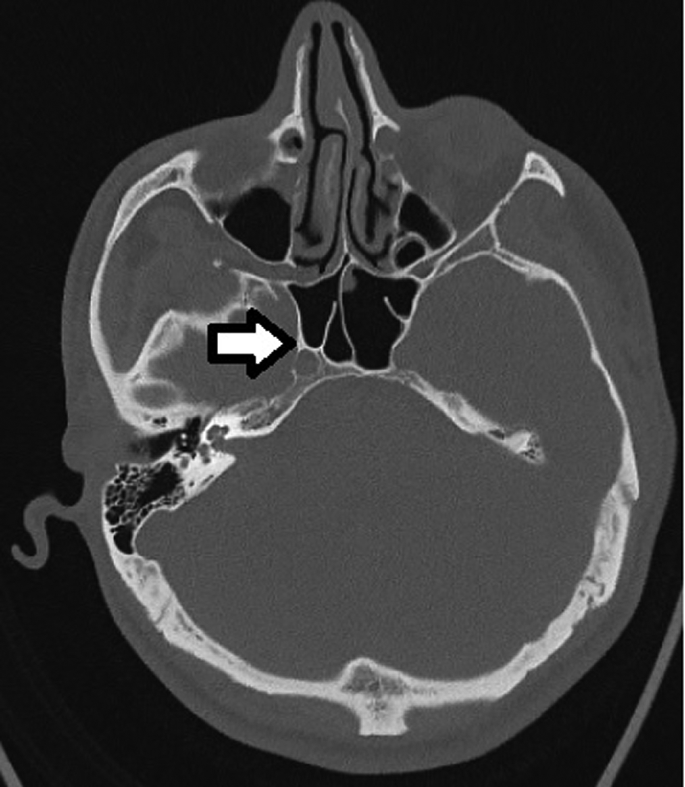 Association of accessory sphenoid septa with variations in neighbouring ...