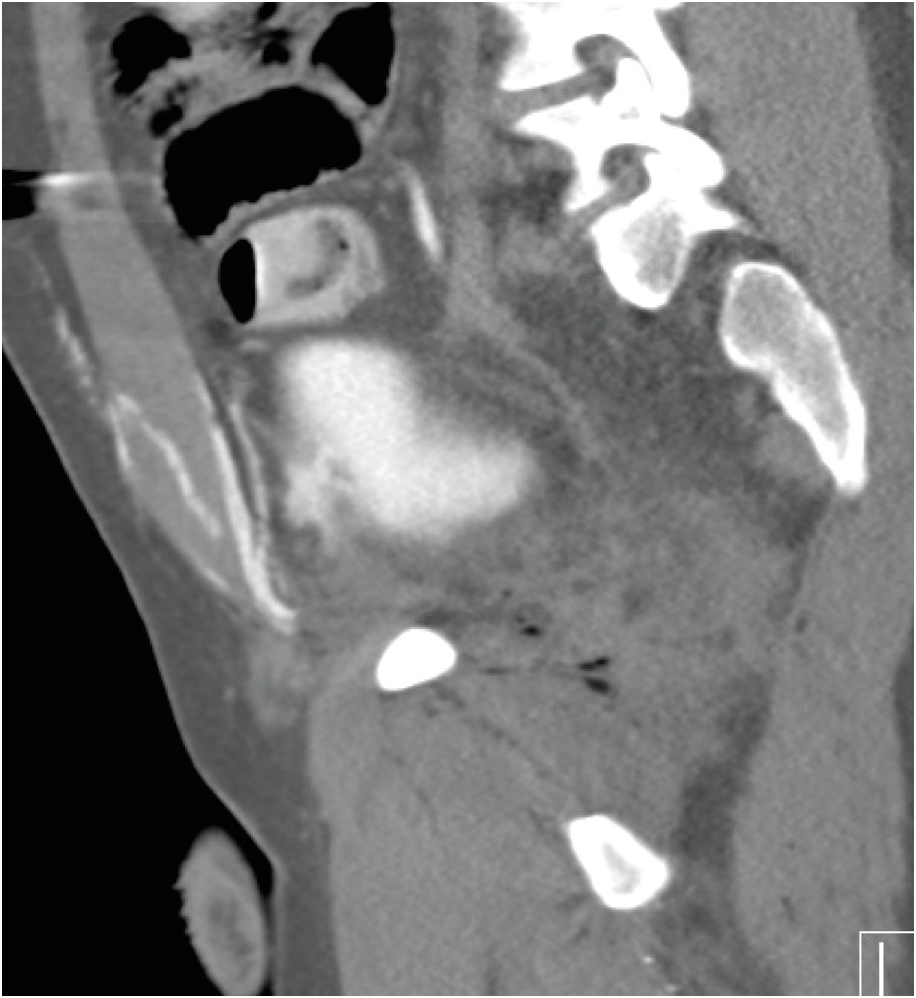 Retroperitoneal hemorrhage due to ruptured renal cyst in PCKD, Radiology  Case