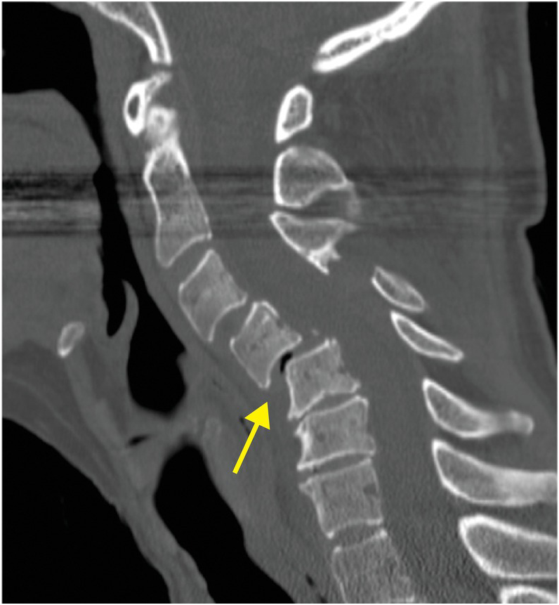 Trauma X-ray - Axial skeleton - Thoracolumbar spine - Normal anatomy