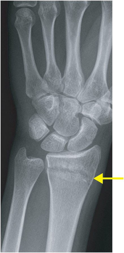 Colles vs Smith Fracture X-ray Findings, Distal Radius Fracture, Xray  Wrist Fracture