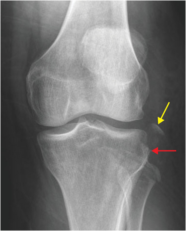 MR images of deltoid ligament anatomy. Coronal proton-density fast