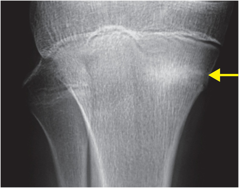 52-year-old male status post motorcycle trauma (Case 81) - Emergency Radiology COFFEE Case Book 52-year-old male status post motorcycle trauma (Case 81) - Emergency Radiology COFFEE Case Book