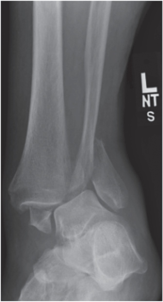PDF] Deltoid Ligament Rupture in Ankle Fracture: Diagnosis and